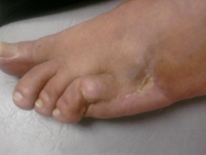 diabetic foot ulcer healed
