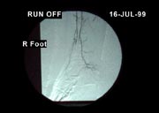 toe wound angiogram