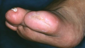 toe wound healed