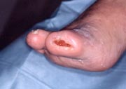toe wound2