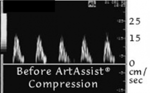 doppler pulse before artassist